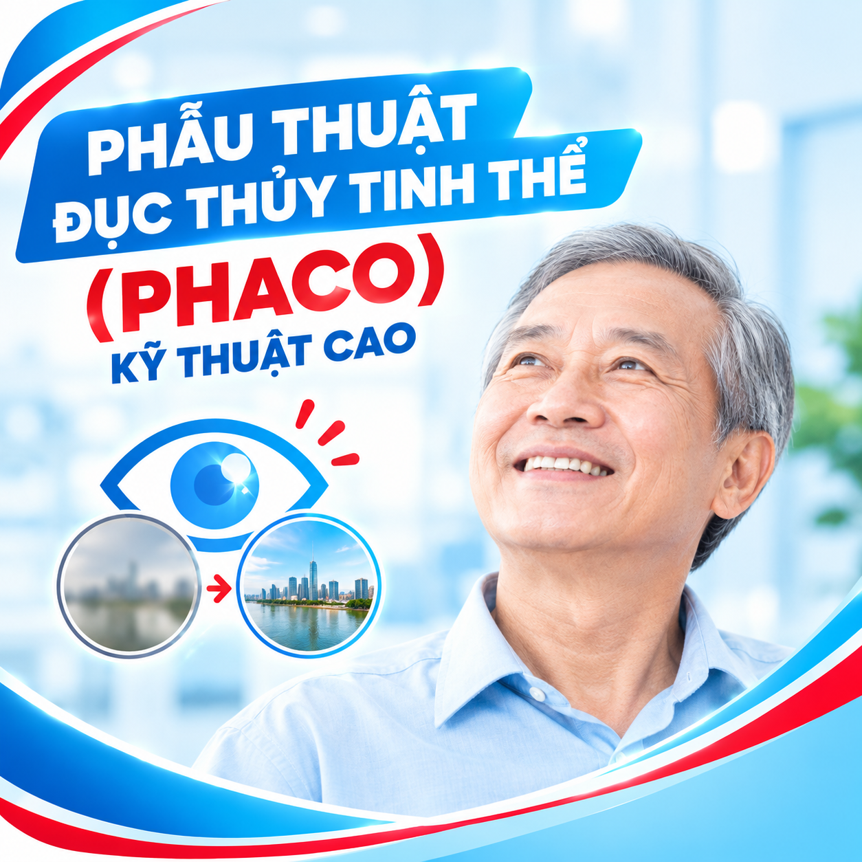 Phẫu Thuật Đục Thủy Tinh Thể (Phaco Kỹ Thuật Cao)